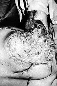 Fig. 7 - Left shoulder reconstructed by means of transposition of m. latissimus dorsi covered with meshed autografts.