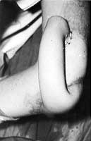 Fig. 9a - Tubed flap approachingin stages the destroyed shoulder.