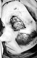 Fig. 11 - Low-voltage contact burn in 29-year-old man