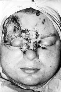 Fig. 13a - Destruction of supraorbital and periorbital region and of radix nasi.