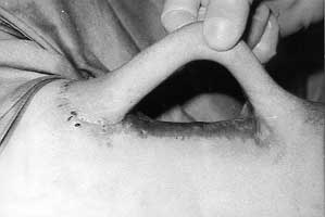 Fig. 14 - Tube pedicle flap prepared on left arm.