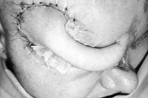 Fig. 15a - Tube pediele flap transferred and divided to close supraorbital region and radix nasi (glabella)