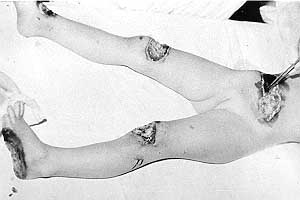 Fig. 18 - Deep necrosis in trunk, both knees and foot in 4-year-old girl.