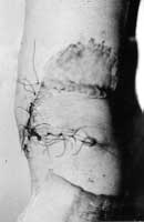 Fig. 19 - Transposition flaps covering