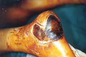 Fig. la - Electrical burn.