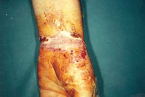 Fig. lb - Electrical burn.