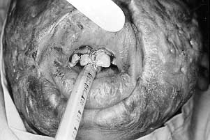 Fig. 1 - Patient with severe facial keloids, one year post-burn. Interdental wires affixed to bilateral central upper incisors. Note indentation into endotracheal tube from wire securing tube to teeth