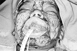 Fig. 2 - After excision of diffuse facial keloids. Attachment of tube to teeth obscured by oral packing.