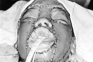 Fig. 3 - Immediately after application of unmeshed split-thickness skin grafts to excised facial units.