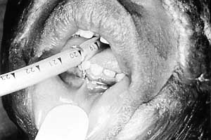 Fig. 4 - Interdental wires affixed to bilateral central lower incisors when upper teeth are missing. This is our second choice of fixation, as mandibular motion may result in slight telescoping of the endotracheal tube.