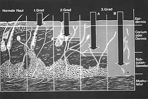 Fig. 1 - Different areas of cutis damaged by heat. These specific areas determine the graduation of the burn status.