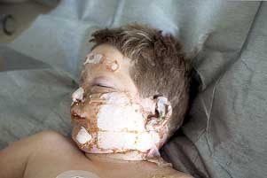 Fig. 2 - Child's face, first- and second-degree burns. Burned areas covered with fresh sterile frozen porcine skin. The immediate adherence of the protein-rich fluid of the wound is visible. We thus have open wound treatment conditions.