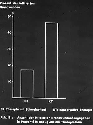 Fig. 3 - Low rate of local infection achieved with use of primary wound dressing with fresh sterile frozen porcine skin.