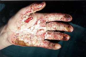 Fig. 6 - Local situation of severely burned hand.