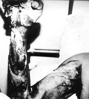 Fig. 5 - Very extensive tissue damage seen in a high-voltage injury.