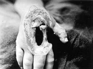 Fig. 6 - Severe hand injury in child caused by a low-voltage current.