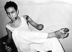 Fig. 7 - Multiple deep burns and below-elbow amputation after lowvoltage injury.