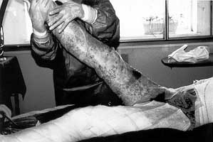Fig. 3 - Allografts applied under aseptic conditions on, deepithelialized skin, using only xeroform gauze without any fi~,ation system.