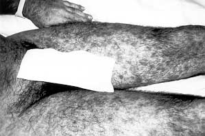 Fig. 5a - Case 1. Exfoliative disorder all over body surface.