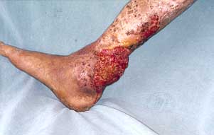 Fig. 1 - Patient G.M., aged 57 years. Verrucous carcinoma in longstanding burn sequelae (30 years) in right lower limb.