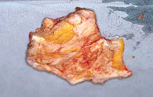 Fig. 2 - Intra-operative view of excised lesion without macroscopic signs of deep fascial infiltration.