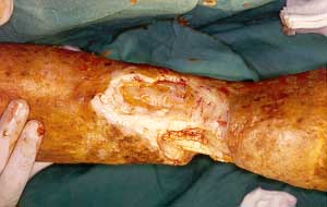 Fig. 3 - Surgical wound, showing depth of exeresis,