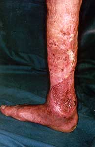 Fig. 4 - Follow-up at six months showing small areas of spontaneous healing after biopsies with verrucous carcinoma recidivation.
