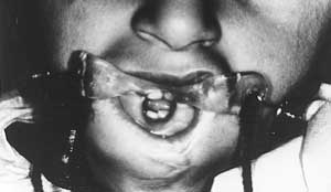 Fig. 2 - (above) Lower lip appearance after simple scar excision and limited commissuroplasty; (below) Lower lip expanded. The same apparatus is used to deepen the labial sulcus.