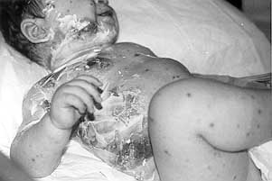 Fig.1- Infant with post-viral toxic epidermal necrolysis.