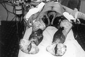 Fig. 2a - Young patient with inadequately managed toxic epic necrolvsis resultimi in full-thickness skin necrosis.