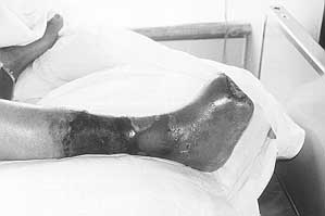 Fig., 2b - Same patient after transmetatarsal amputation of foe
