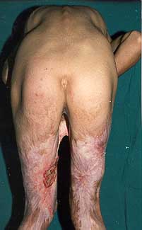 Fig. 1b - Pre-operative posterior view.