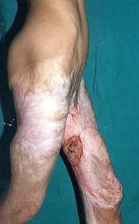 Fig. lc - Pre-operative lateral view.