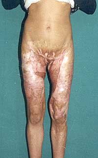 Fig. 3a - Post-operative anterior view.