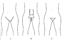 Fig. 2 - Drawings of the procedure. A) Anterior side of flap design. B) Planning of Z-plasty on posterior side after elevation of flap. Q Final shape of pubic area after operation.