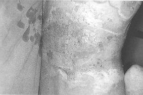 Fig. 4c - Positioning of autologous keratinocyte sheets mounted on petrolatum gauze (above) and on Veloderm (below).