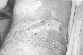 Fig. 4e - Medication on day 4 - comparison of sheets mounted on petrolatum gauze and on Veloderm.
