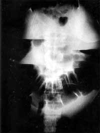 Fig. 2 - Abdominal x-ray in erect position. Excessive dilatation of colon with concomitant air fluid levels.