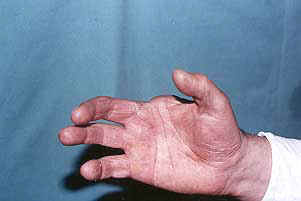 Fig. 3b - Exenple de l'amputation inévitable