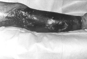 Fig. 1 - Appearance of burned leg 12 h after application of methylene blue dye. Notice the variable coloration of the bum surface in relation to the variable depth of the thermal injury.