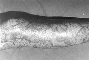Fig. 3 - Final acceptable result after grafting of excised areas.