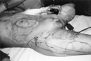 Fig. 1 - Skin markings for the procedure, depicting the, defect, the tensor fasciae latae muscle, the skin island, and the lateral circumflex femoral vessels.