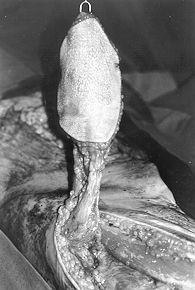 Fig. 2 - Full-thickness defect and flap ready to be transposed. The lateral circumflex femoral vessels can be seen in the base of the flap.