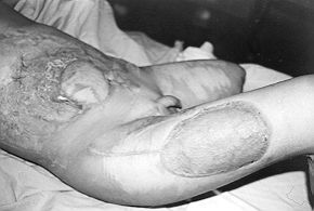 Fig. 4 - Late post-operative result. The distal part was debrided and skin was grafted over the viable fascia.