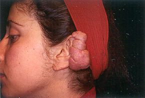 Figs. 1 - Keloid in right auricle.
