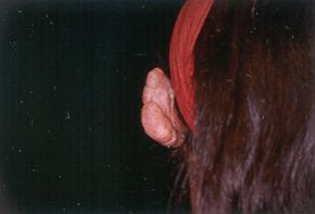 Figs. 2 - Keloid in right auricle.