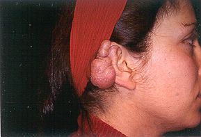 Figs. 3 - Keloid in left auricle.