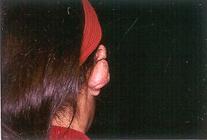 Figs. 4 - Keloid in left auricle.