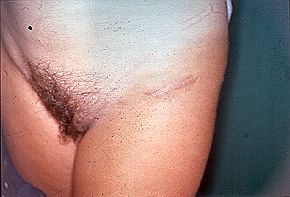 Fig. 9 - Normal scarring process in inguinal donor site.