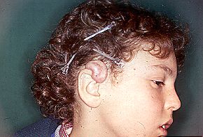 Figs. 10 - Keloid in upper third of auricle.
